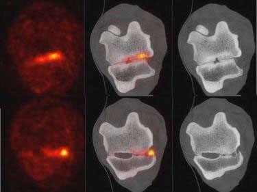 Bella's bone scan images